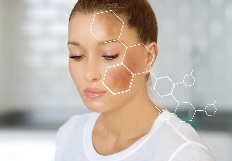 Psoriasis & Pigmentation treatment at Klinik Astracare